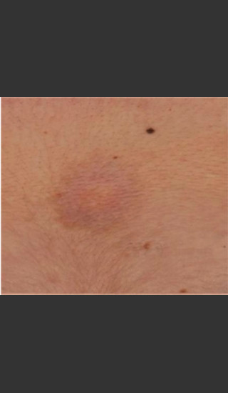 After Photo for Treatment of Tattoo -  - Prejuvenation