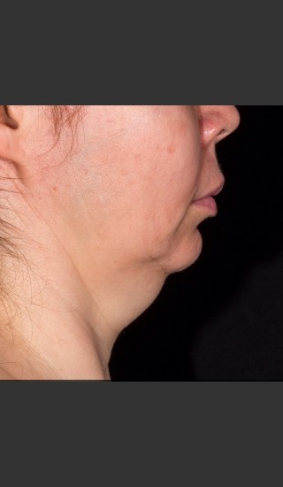 Before Photo for SculpSure Submental - Bruce E Katz, M.D. - Prejuvenation