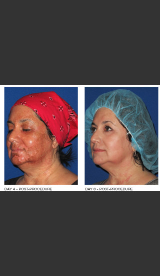 After Photo for Alastin Skincare Procedure Enhancement System -  - Prejuvenation