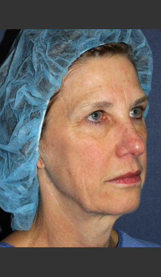 Before Photo for Treatment of Sun Damage - Mitchel P. Goldman M.D. - Prejuvenation