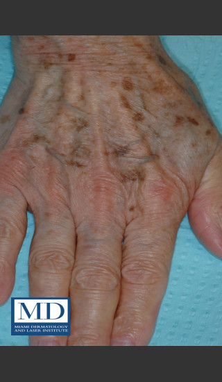 Before Photo for Brown Spots on Hands Treatment 113 - Jill S. Waibel, MD - Prejuvenation