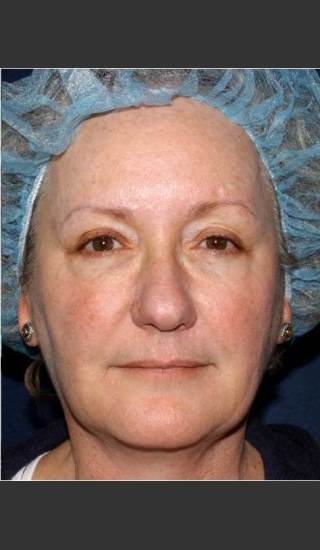 After Photo for Treatment of Sun Damage & Flushing - Kimberly J. Butterwick M.D. - Prejuvenation