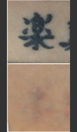 Before Photo for Laser Treatment of Tattoo -  - Prejuvenation