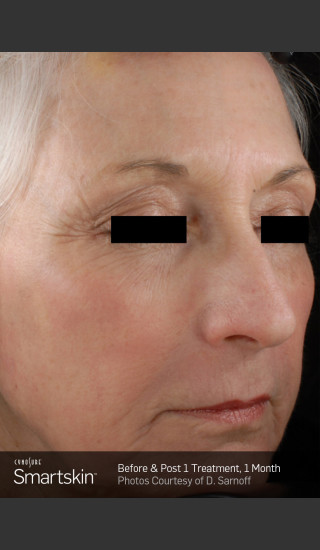 After Photo for Wrinkle Reduction With SmartSkin Resurfacing -  - Prejuvenation