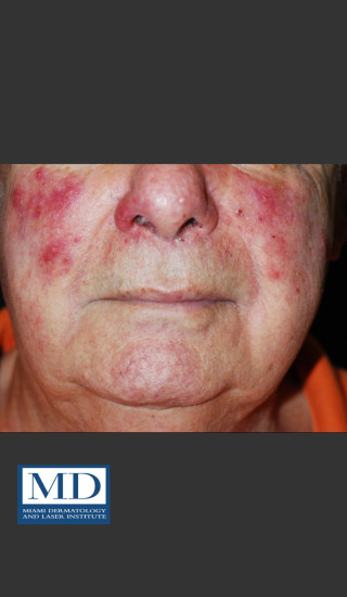 Before Photo for Rosacea Treatment 102 - Jill S. Waibel, MD - Prejuvenation