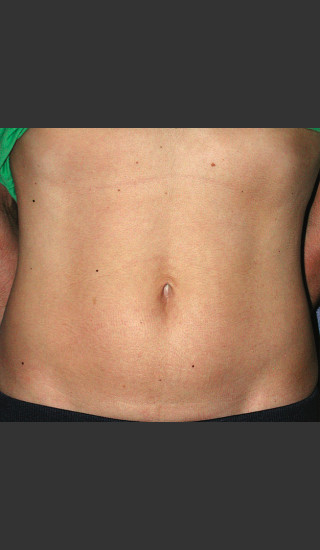 After Photo for Thermage Procedure Before and After III -  - Prejuvenation