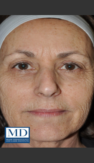 Before Photo for Wrinkle Treatment 124 - Jill S. Waibel, MD - Prejuvenation