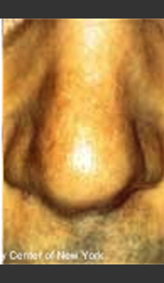 After Photo for Treatment of Nose Blood Vessels -  - Prejuvenation