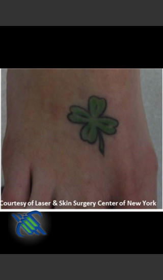 Before Photo for Laser Treatment of Foot Tattoo - Roy G. Geronemus, M.D. - Prejuvenation