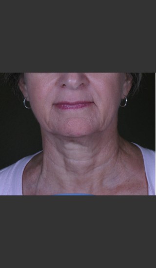 Before Photo for 3DEEP Neck Tightening -  - Prejuvenation