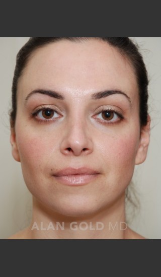After Photo for Rhinoplasty 1683 - Alan Gold MD - Prejuvenation
