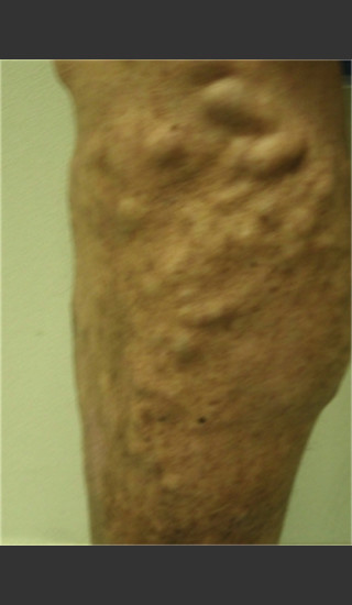 Before Photo for Treatment of Leg Veins -  - Prejuvenation