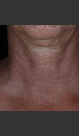 Before Photo for Alastin Skincare Restorative Neck Complex with TriHex Technology® -  - Prejuvenation