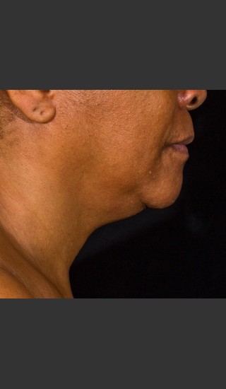 After Photo for SculpSure Submental - Bruce E Katz, M.D. - Prejuvenation