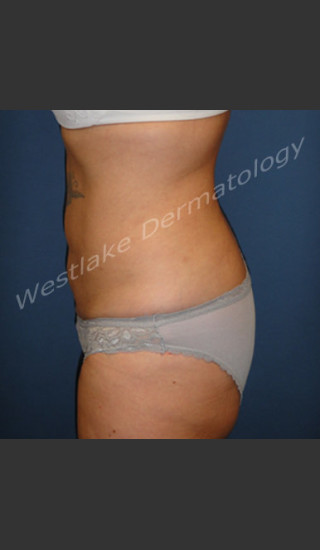 After Photo for SmartLipo Liposuction of Female Abdomen - Cameron Craven MD FACS - Prejuvenation