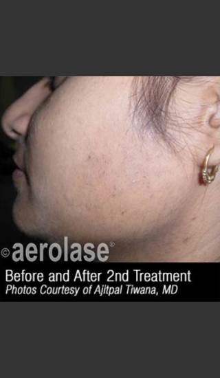 After Photo for Hair Removal #310 -  - Prejuvenation