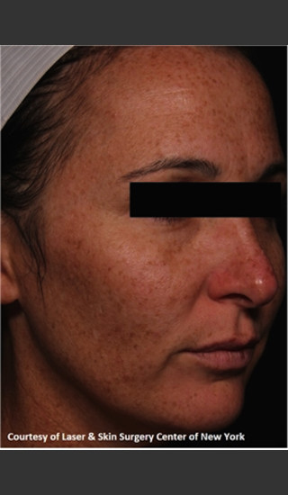 Before Photo for Facial Skin Rejuvenation with Clear and Brillant Permea - Roy G. Geronemus, M.D. - Prejuvenation