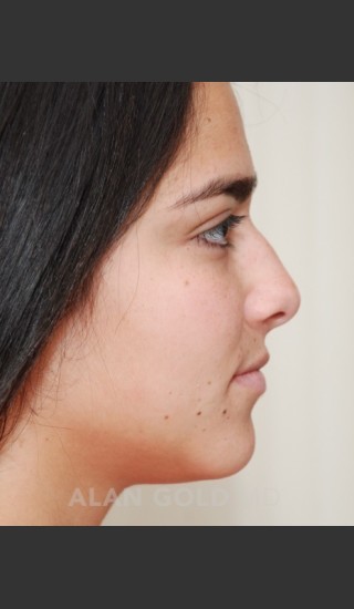 Before Photo for Rhinoplasty 1676 Side View - Alan Gold MD - Prejuvenation
