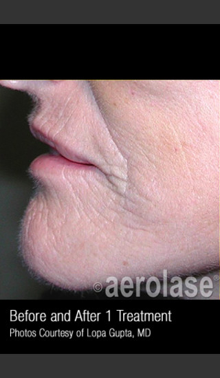 After Photo for Treatment of Wrinkles, Tone and Texture #341 -  - Prejuvenation