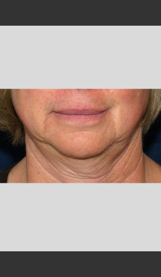 Before Photo for Profound Lower Face Lift Treatment -  - Prejuvenation