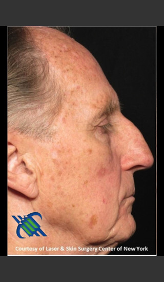 Before Photo for Full Face Treatment with Fraxel Right Side  - Roy G. Geronemus, M.D. - Prejuvenation