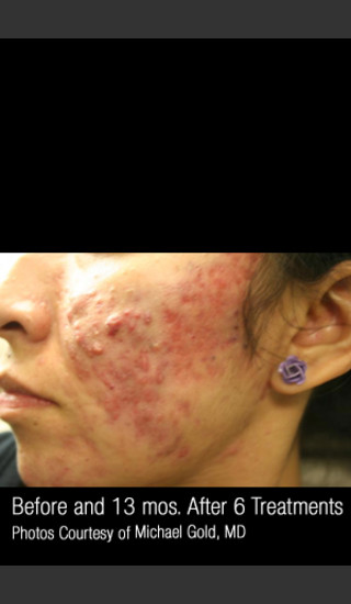 Before Photo for #301 - Treatment of Cystic Acne -  - Prejuvenation