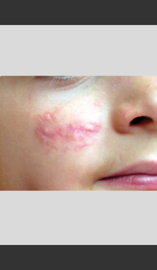 Before Photo for Vbeam. Pulsed Dye Laser treatment of Scars -  - Prejuvenation