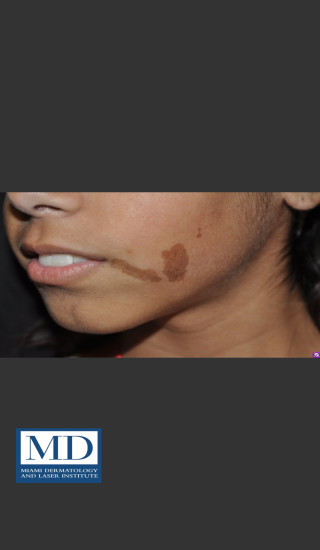 Before Photo for Birthmark Cafe Au Lait Macule Treatment 112 - Jill S. Waibel, MD - Prejuvenation
