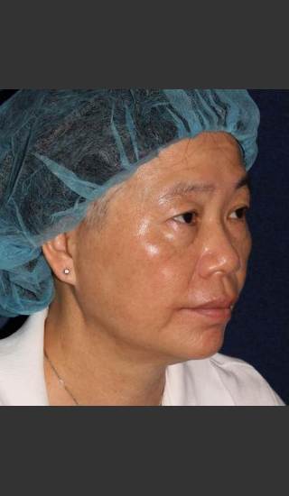 After Photo for Sun Spot Reduction - William F. Groff, M.D. - Prejuvenation