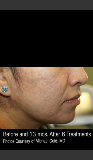 After Photo for Treatment of Cystic Acne #302 -  - Prejuvenation