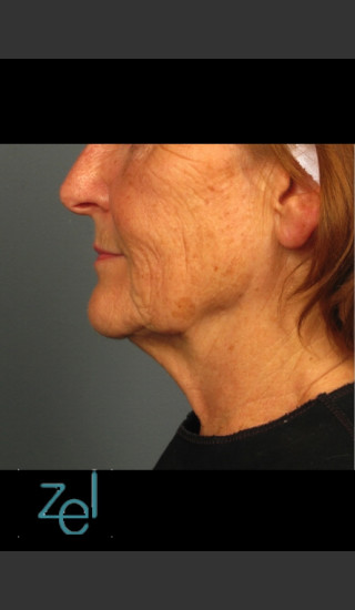 Before Photo for Ultherapy on Mid Face with Dermal Fillers - Brian D. Zelickson, M.D. - Prejuvenation
