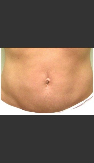 After Photo for 3DEEP Belly Tightening -  - Prejuvenation