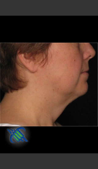 After Photo for Laser Liposuction Left Side of Neck - Roy G. Geronemus, M.D. - Prejuvenation