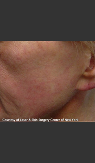 After Photo for Treatment of Facial Blood Vessels -  - Prejuvenation