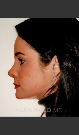 After Photo for Rhinoplasty 194 Side View - Alan Gold MD - Prejuvenation