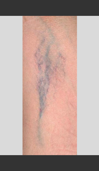 Before Photo for Gentle Laser Vascular Lesions Treatment -  - Prejuvenation