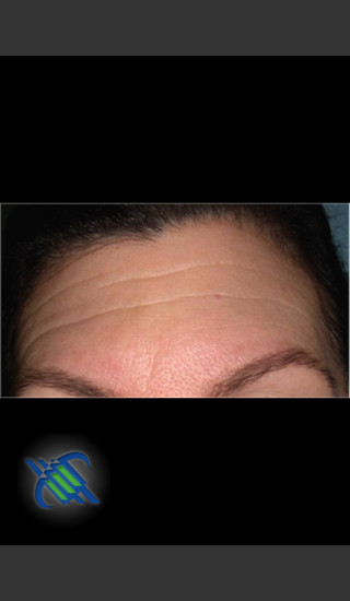 Before Photo for Laser Treatment of Forehead Wrinkles - Roy G. Geronemus, M.D. - Prejuvenation