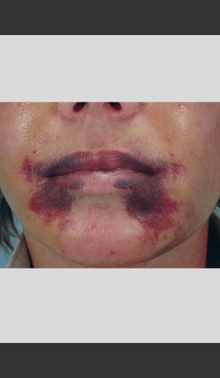 Before Photo for Vbeam Laser of Post-operative Bruising -  - Prejuvenation