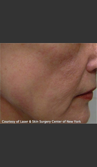 After Photo for Treatment of Facial Blood Vessels -  - Prejuvenation
