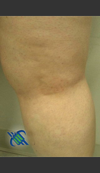 After Photo for Treatment of Leg Veins - Roy G. Geronemus, M.D. - Prejuvenation