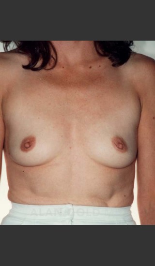 Before Photo for Breast Augmentation 582 - Alan Gold MD - Prejuvenation