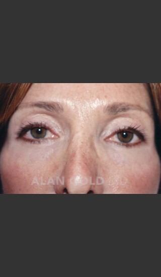 After Photo for Blepharoplasty 1004 - Alan Gold MD - Prejuvenation