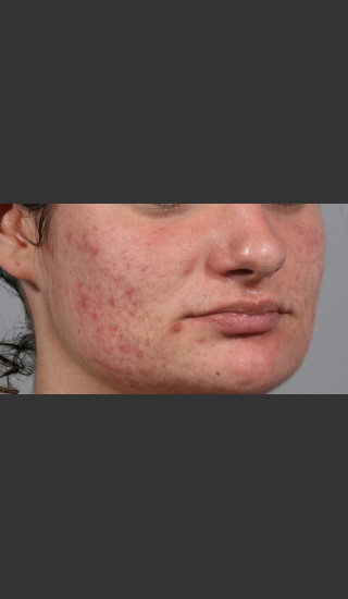 Before Photo for 3DEEP Intensif Microneedling #2 -  - Prejuvenation