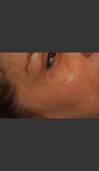 After Photo for Dr. Palmer Vein Removal 01 - Shane Palmer - Prejuvenation