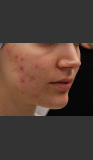 Before Photo for Fractora #1 -  - Prejuvenation