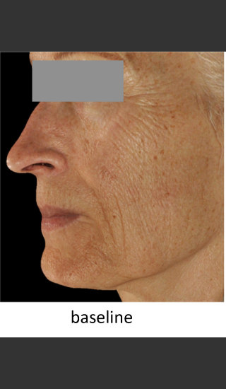 Before Photo for DefenAge Skincare Clinical Power Trio - Amy Forman Taub, MD - Prejuvenation