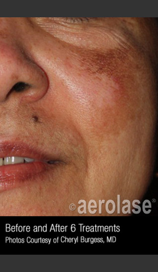 After Photo for Treatment of Melasma #319 -  - Prejuvenation