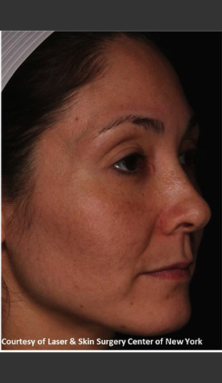 After Photo for Full face Treament with Fraxel - Roy G. Geronemus, M.D. - Prejuvenation
