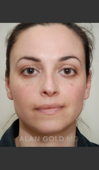 Before Photo for Rhinoplasty 1683 - Alan Gold MD - Prejuvenation