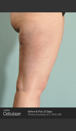 After Photo for Cellulaze Cellulite Treatment of the Thighs -  - Prejuvenation